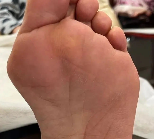 角質除去でフワフワな足裏へ!